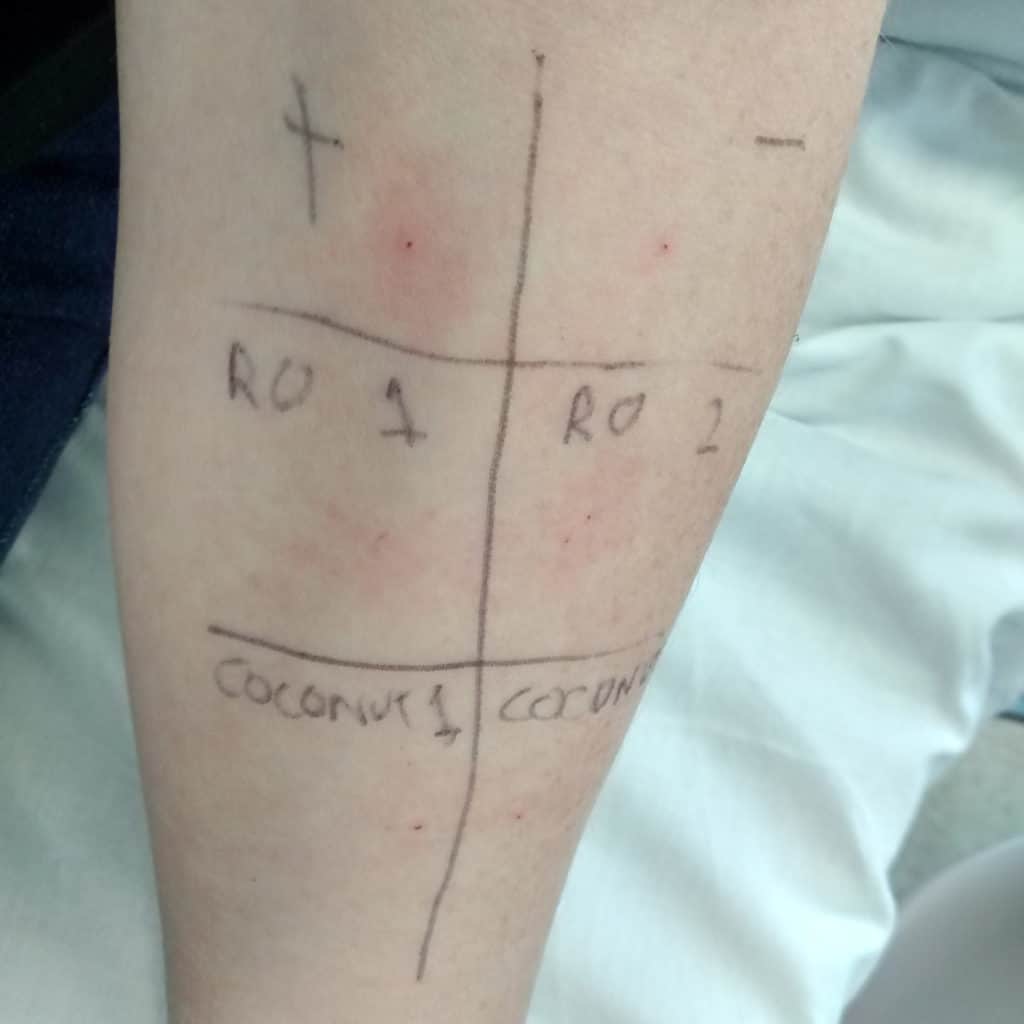 Allergy testing - skin prick testing